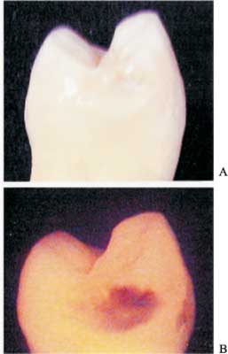 Wykorzystanie Fluorescencji R Nicowej W Diagnostyce Pr Chnicy