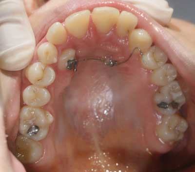 Treatment methods for selected complications of dentin dysplasia type I ...