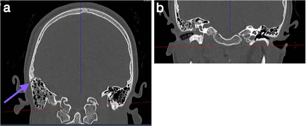 Temporal bone fracture case report New Medicine 3 2022