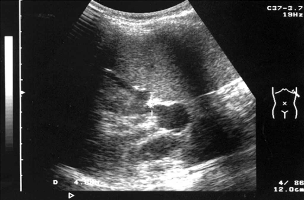 Ultrasound imaging of splenic artery aneurysms • Postępy Nauk ...