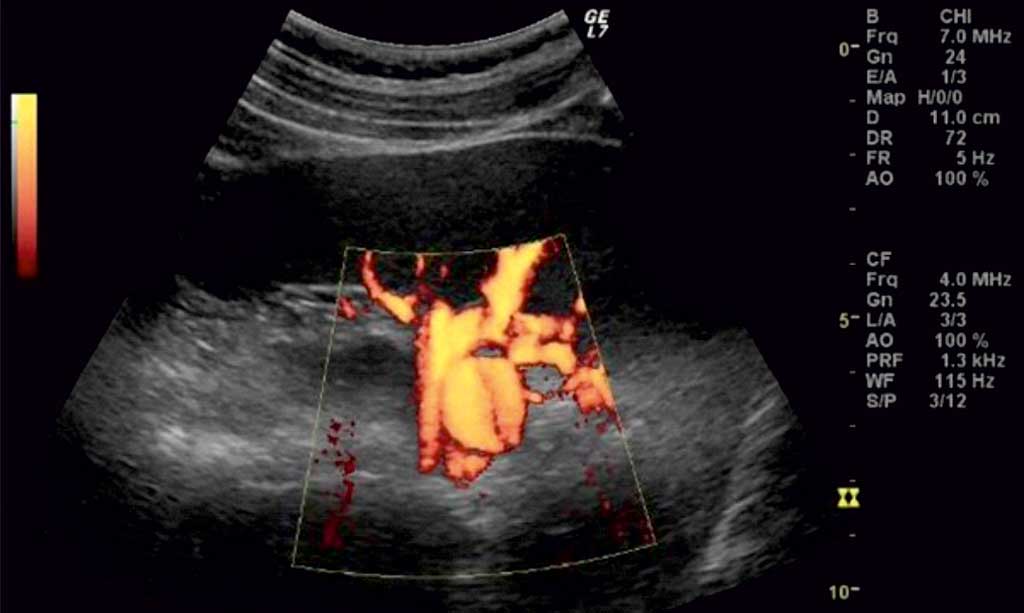 Ultrasound imaging of splenic artery aneurysms • Postępy Nauk ...